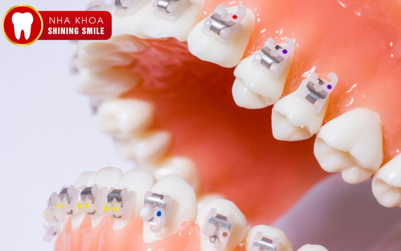 Răng Toàn Sứ: Ưu Điểm Vượt Trội Và Lý Do Nên Chọn